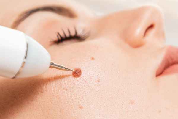 CryoPen: 5 Skin Concerns It May Be Used to Treat 3 What actually happens during a CryoPen treatment Owsestry?